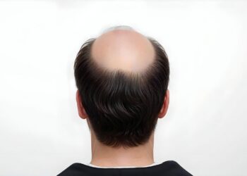 Descubre los efectos ocultos de estos populares medicamentos para la alopecia